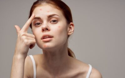 Boutons de stress sur le visage : 10 solutions naturelles